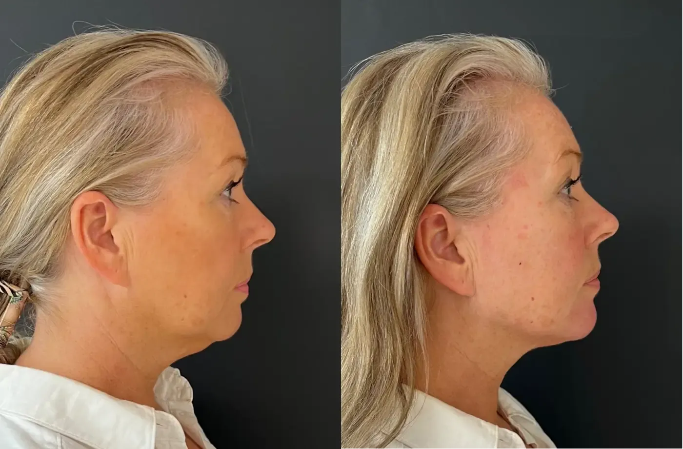 Iris — voor en na fillers