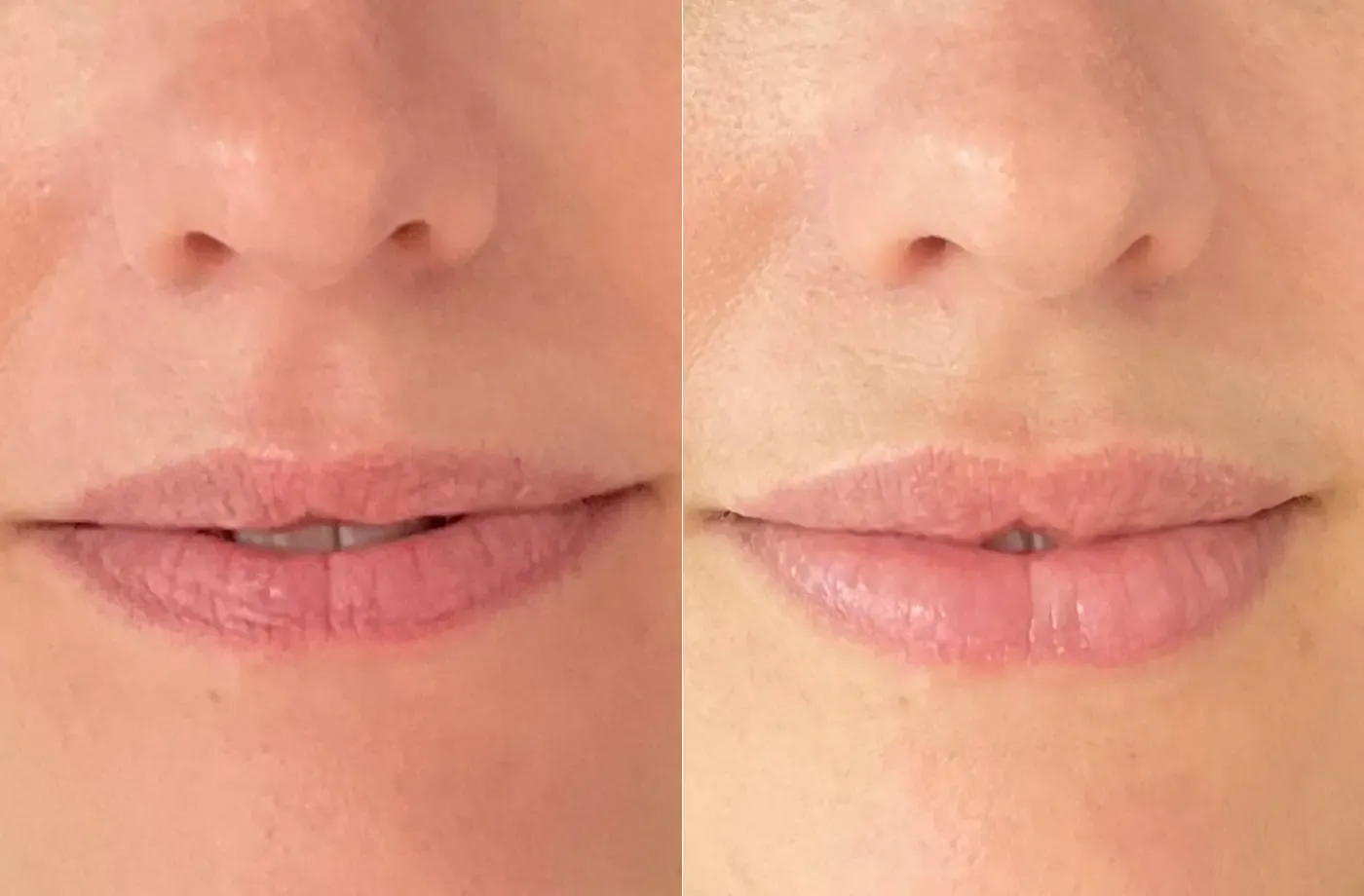 Noa — voor en na fillers