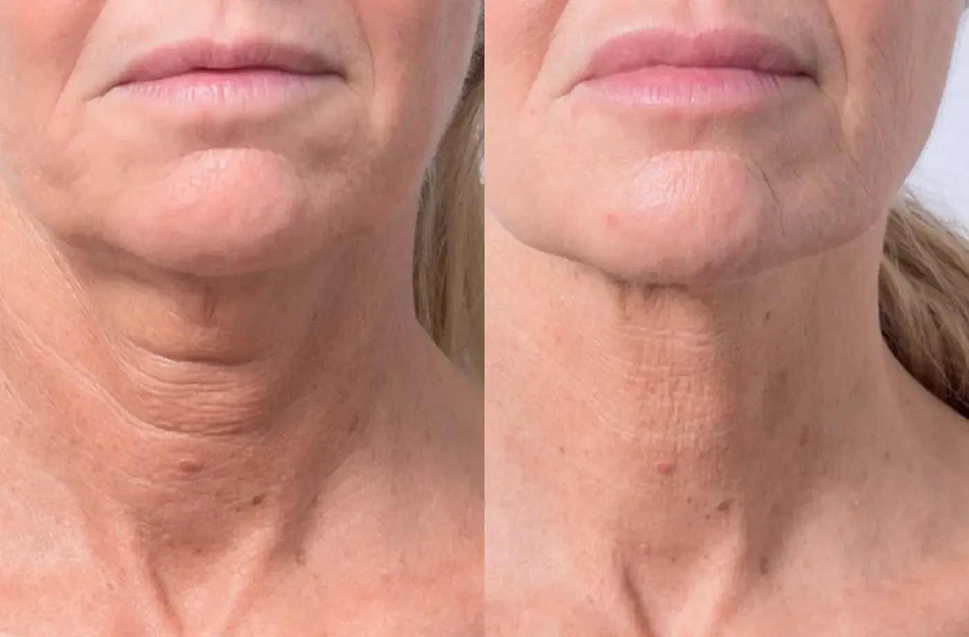 Katrien — voor en na skin boosters