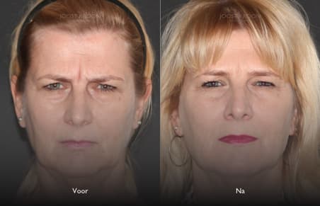Kaat — voor en na botox